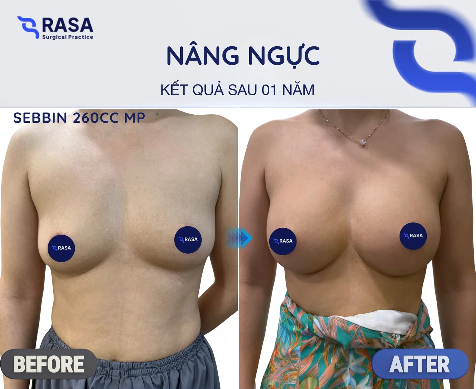 Nâng ngực · Sebbin 260cc - Sau 1 năm