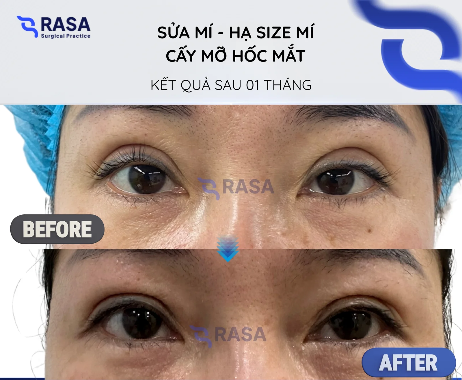 Sửa mí - hạ size mí + cấy mỡ hốc mắt - Sau 1 tháng