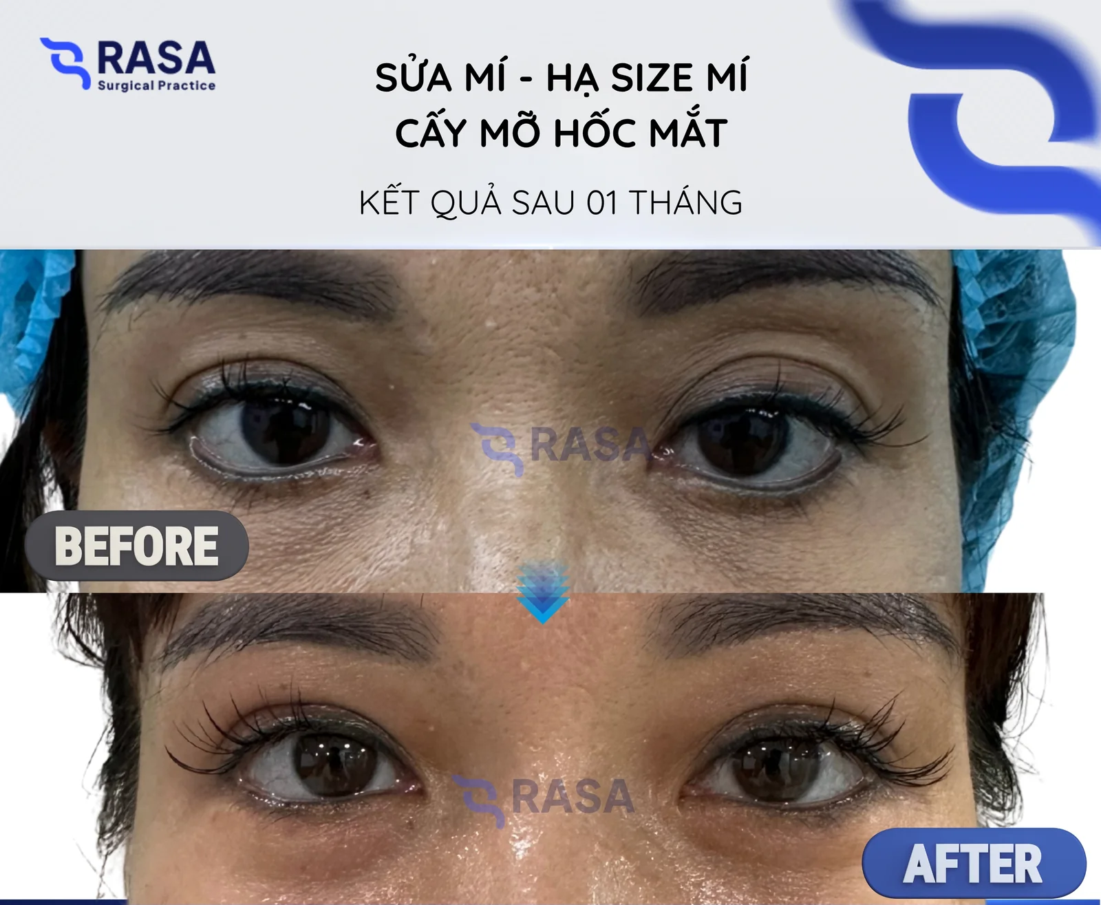 Sửa mí - hạ size mí + cấy mỡ hốc mắt - Sau 1 tháng