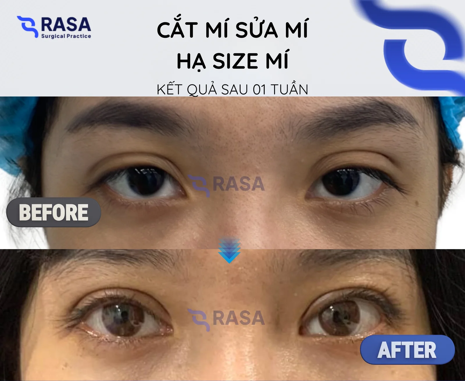 Cắt mí - sửa mí hạ size - Sau 1 tuần