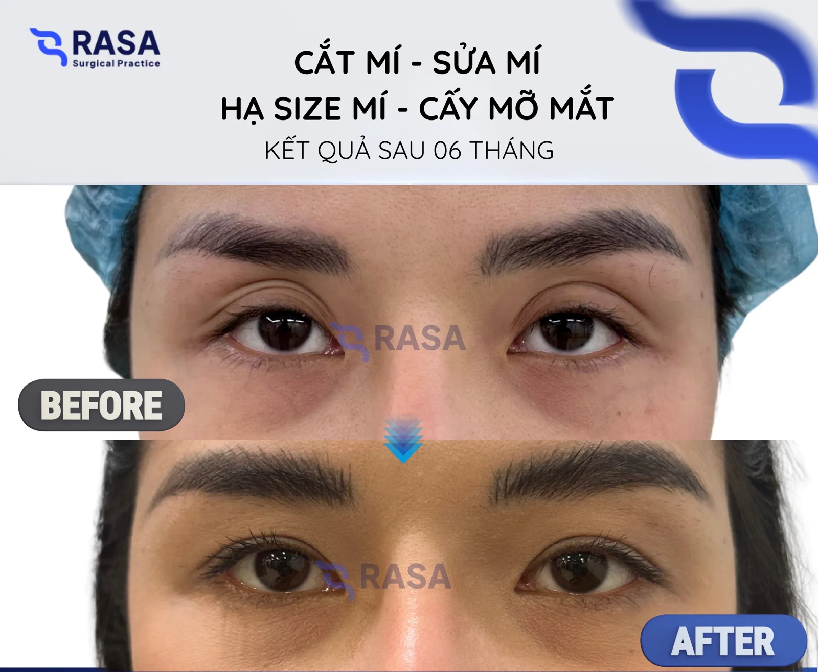 Revision blepharoplasty - crease lowering - fat grafting - After 6 months