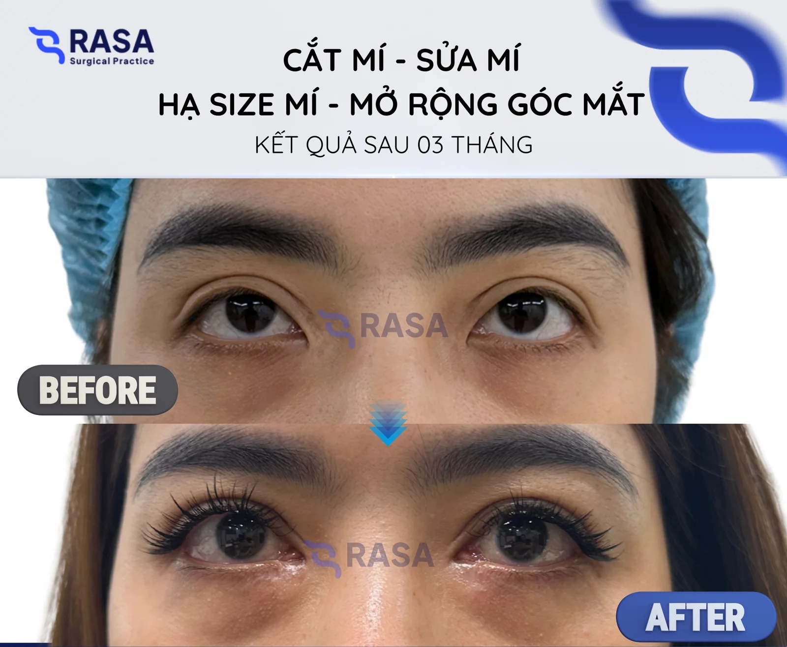 Revision blepharoplasty - crease lowering - epicanthoplasty - After 3 months