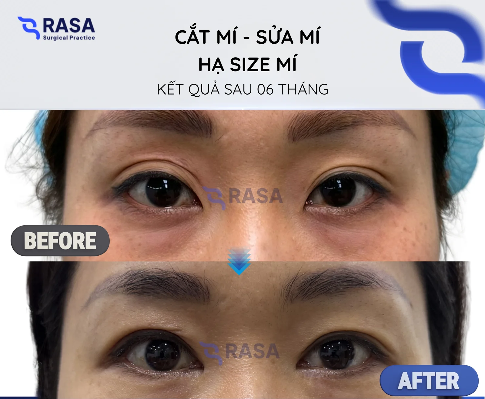 Revision blepharoplasty - crease lowering - After 6 months