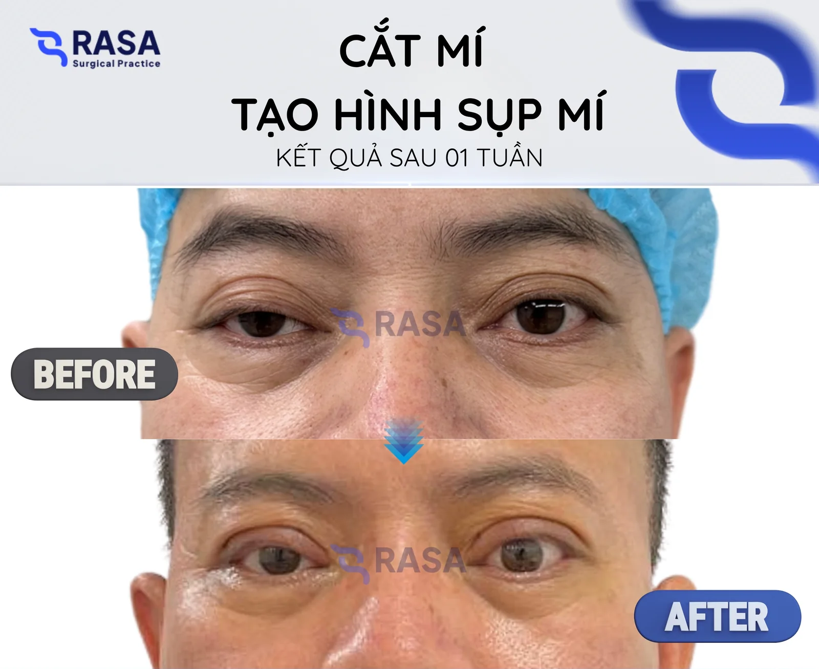 Cắt mí - tạo hình sụp mí - Sau 1 tuần