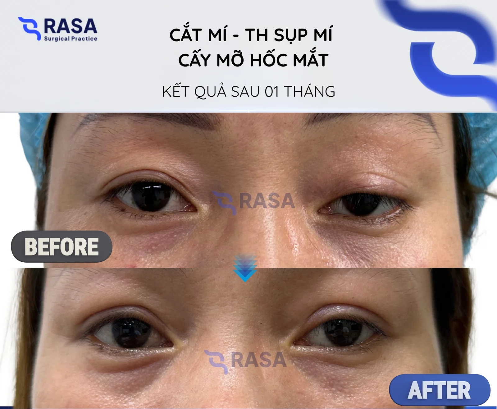 Cắt mí - tạo hình sụp mí + cấy mỡ hốc mắt - Sau 1 tháng
