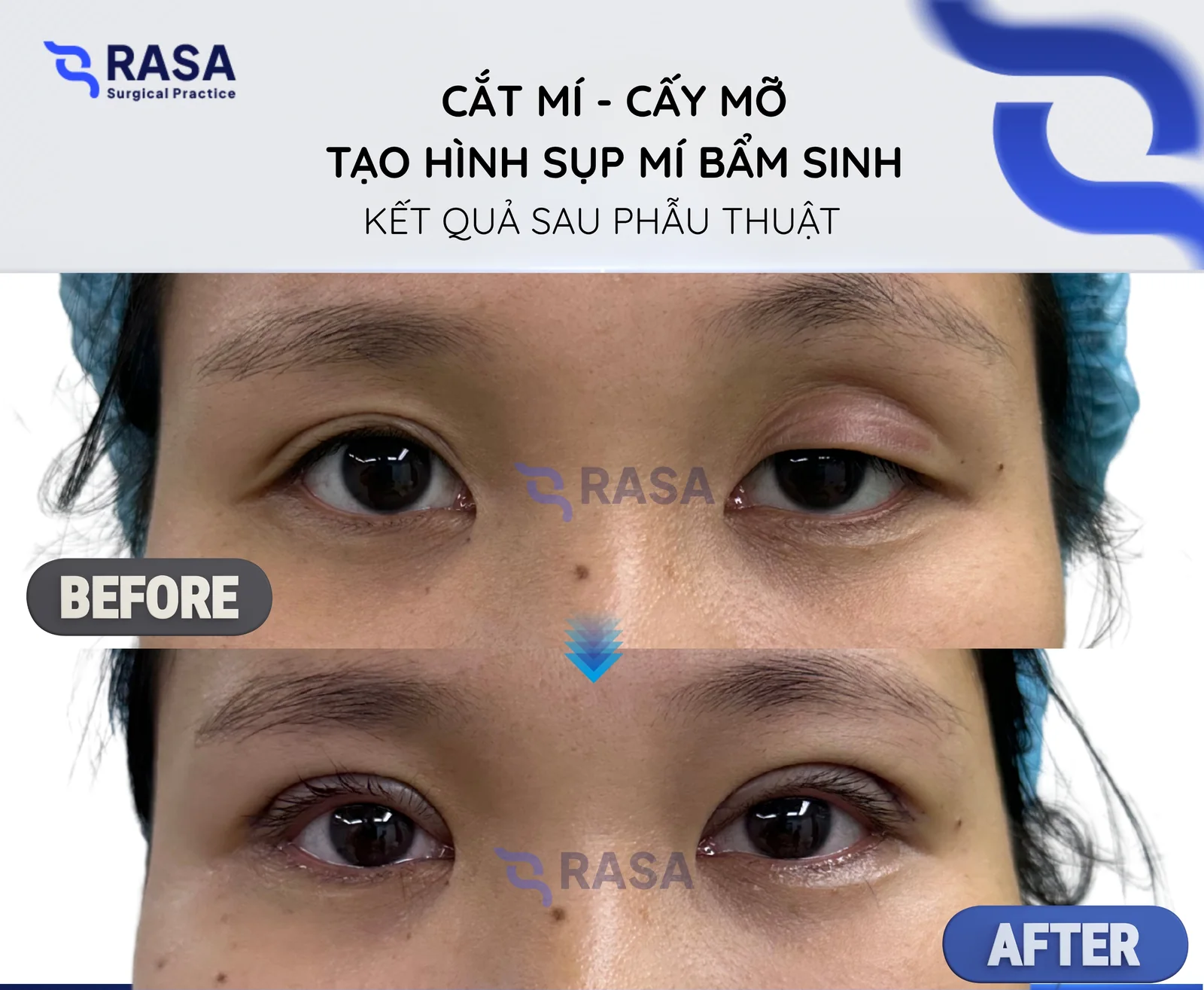 Cắt mí - cấy mỡ, tạo hình sụp mí bẩm sinh - Sau phẫu thuật