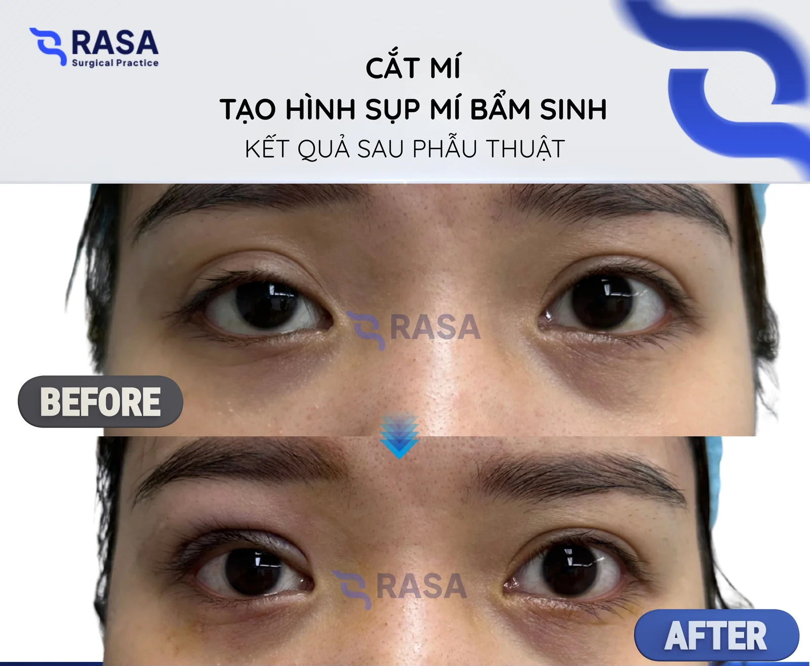 Cắt mí - tạo hình sụp mí bẩm sinh - Sau phẫu thuật