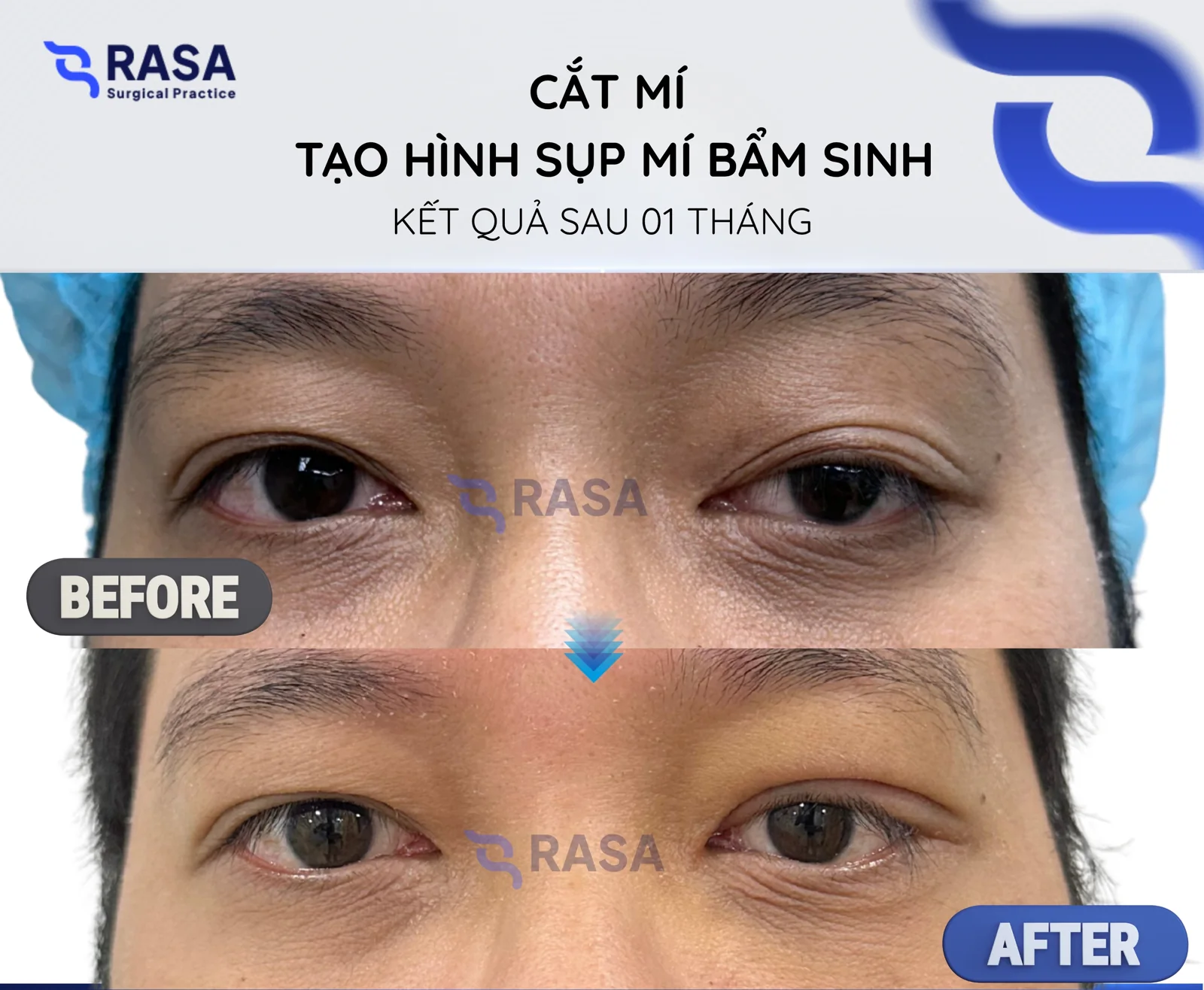Blepharoplasty - congenital ptosis correction - After 1 month