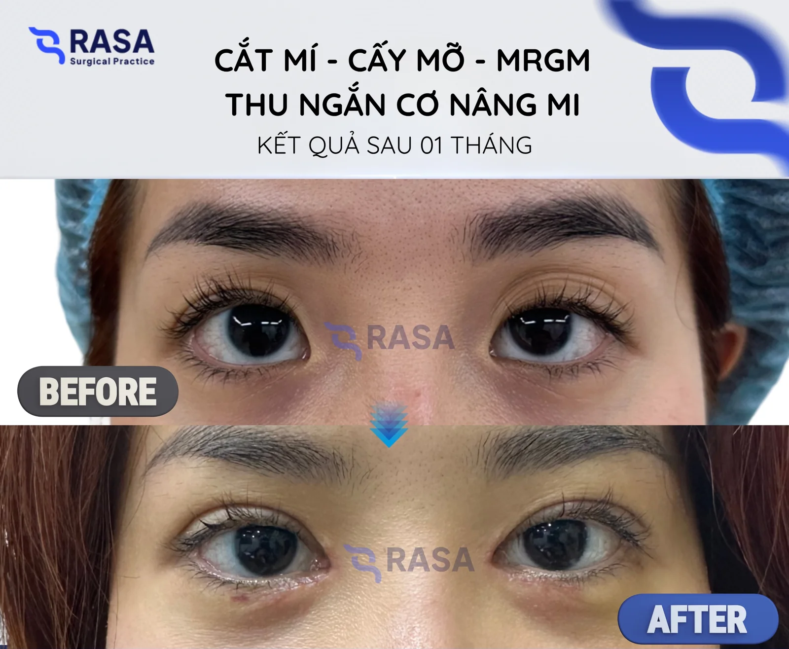 Blepharoplasty - fat grafting - levator resection - After 1 month