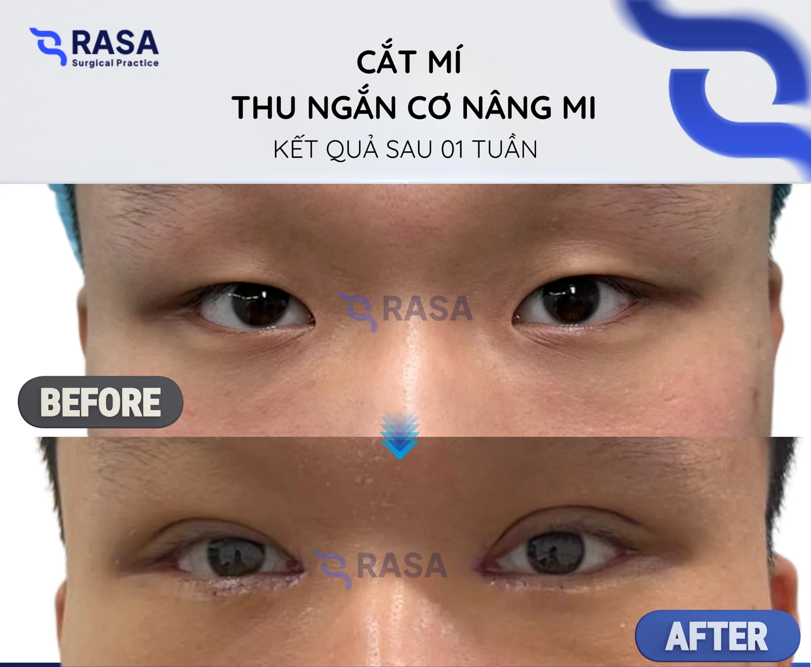 Blepharoplasty - levator resection - After 1 week