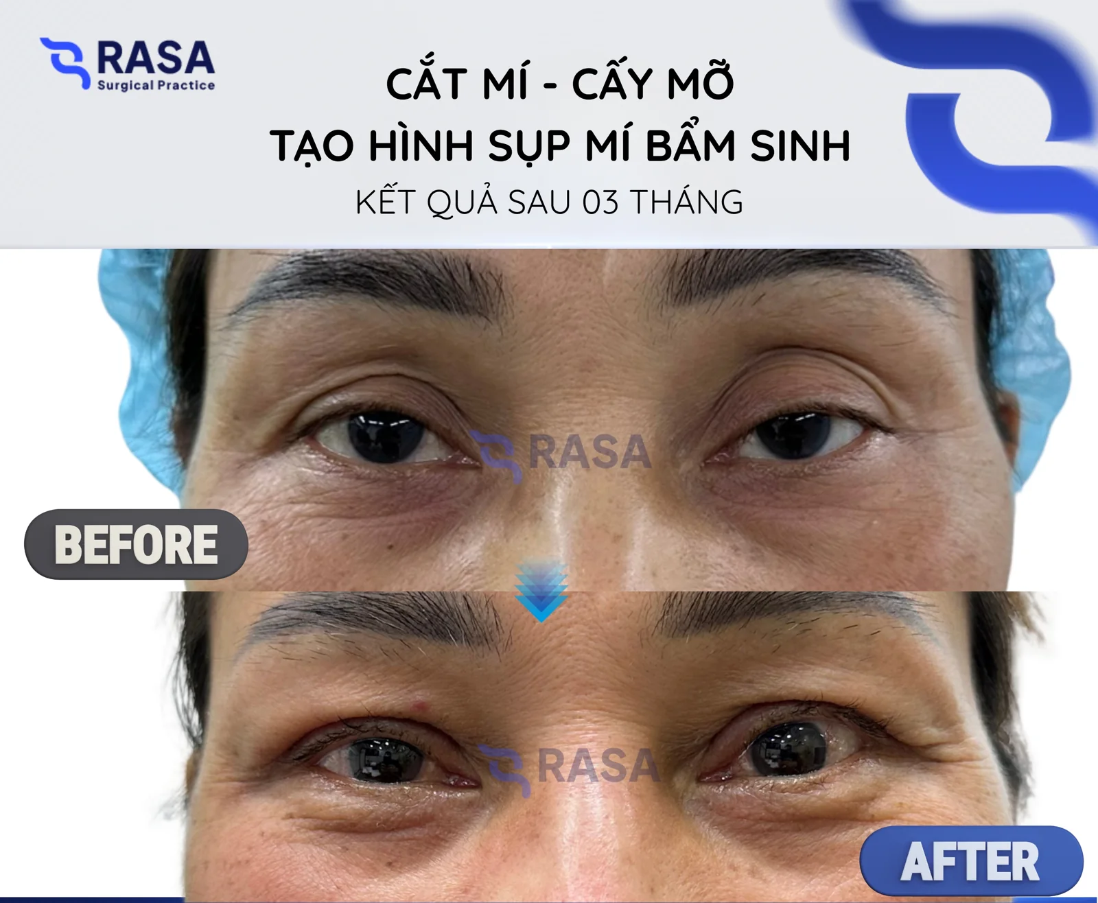 Blepharoplasty - fat grafting - congenital ptosis correction - After 3 months