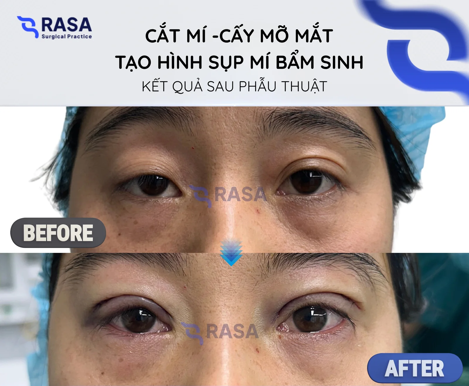 Blepharoplasty - fat grafting - congenital ptosis correction - After post-op