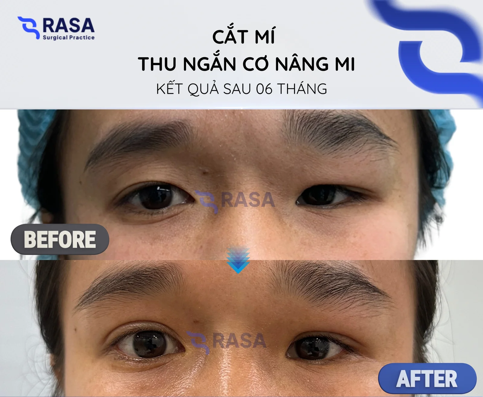 Blepharoplasty - levator resection - After 6 months