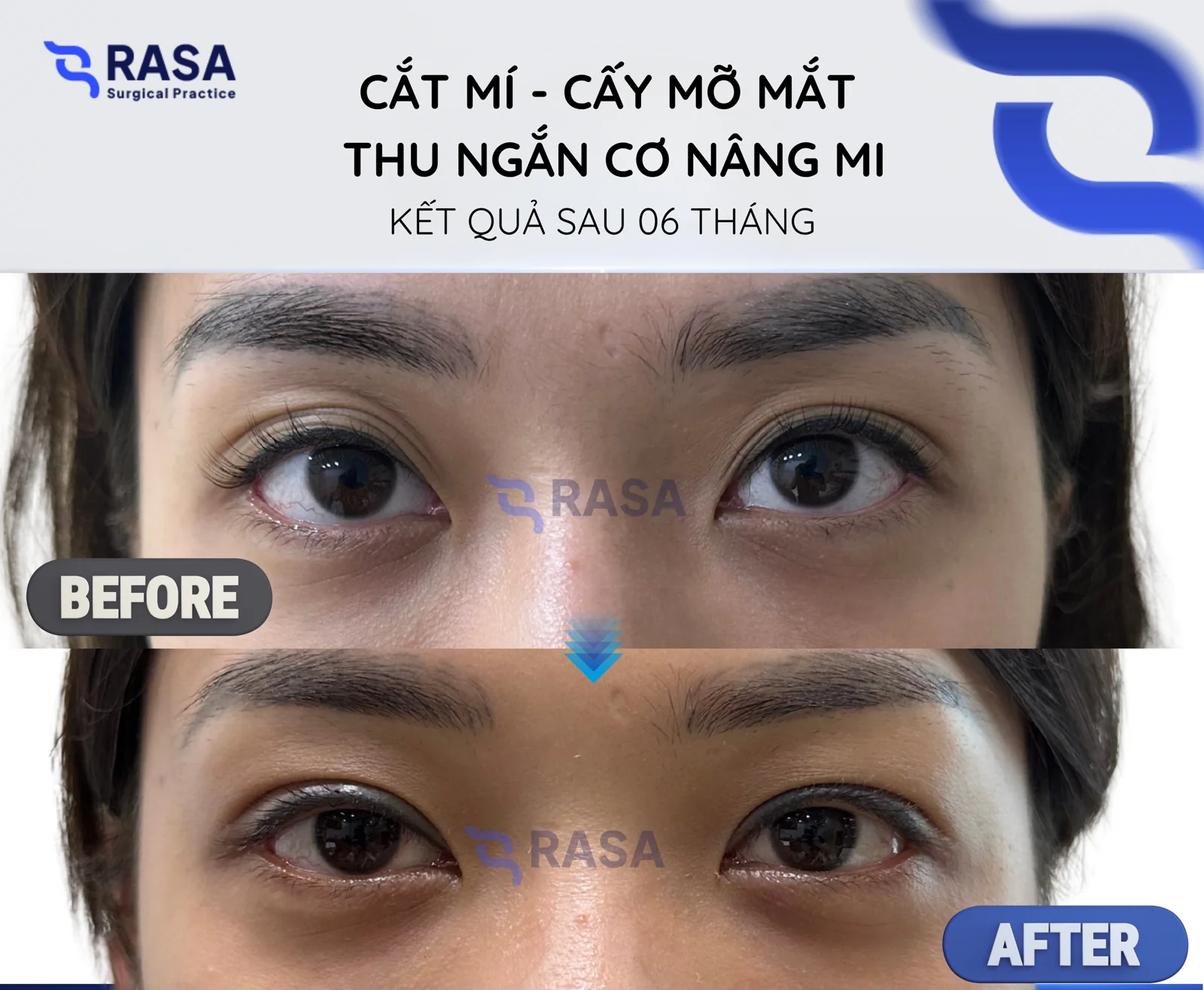 Blepharoplasty - fat grafting - levator resection - After 6 months