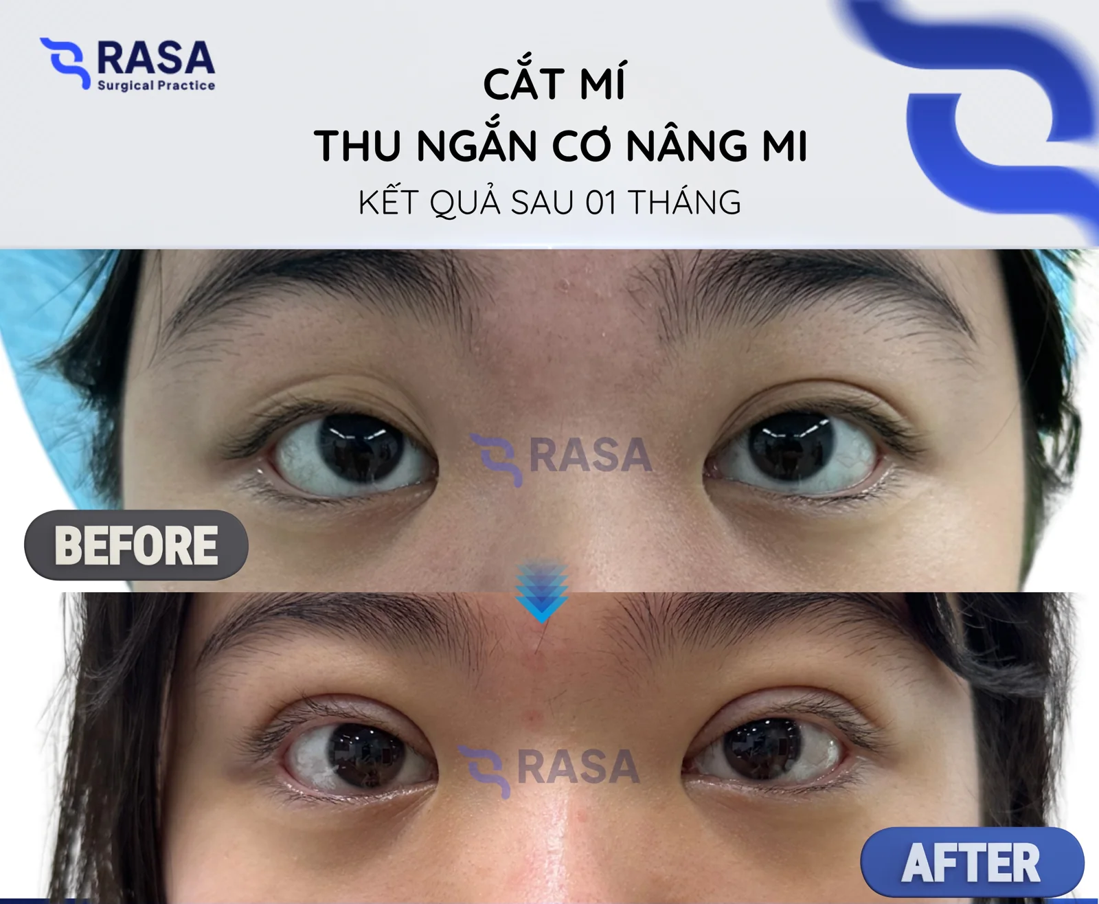 Blepharoplasty - levator resection - After 1 month