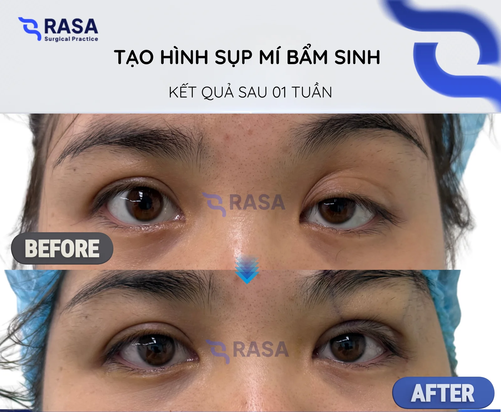 Congenital ptosis correction - After 1 week