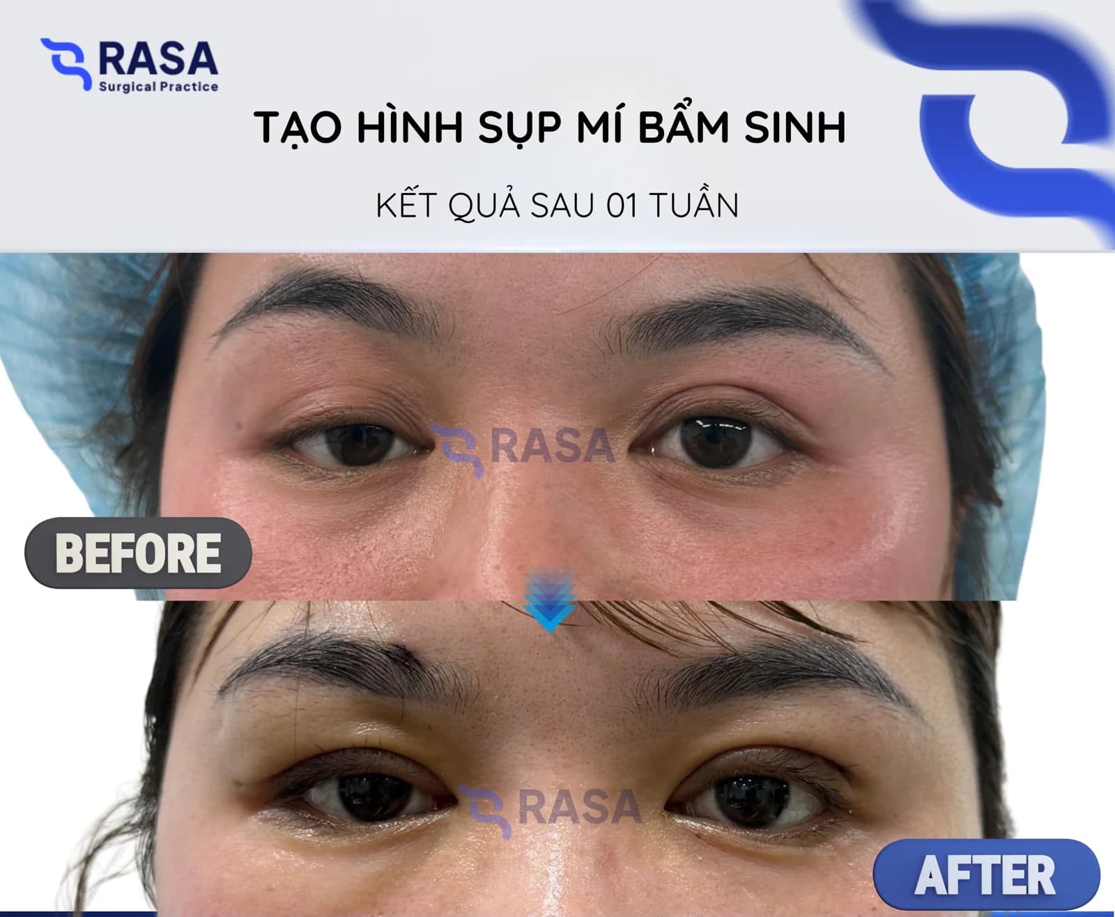 Congenital ptosis correction - After 1 week