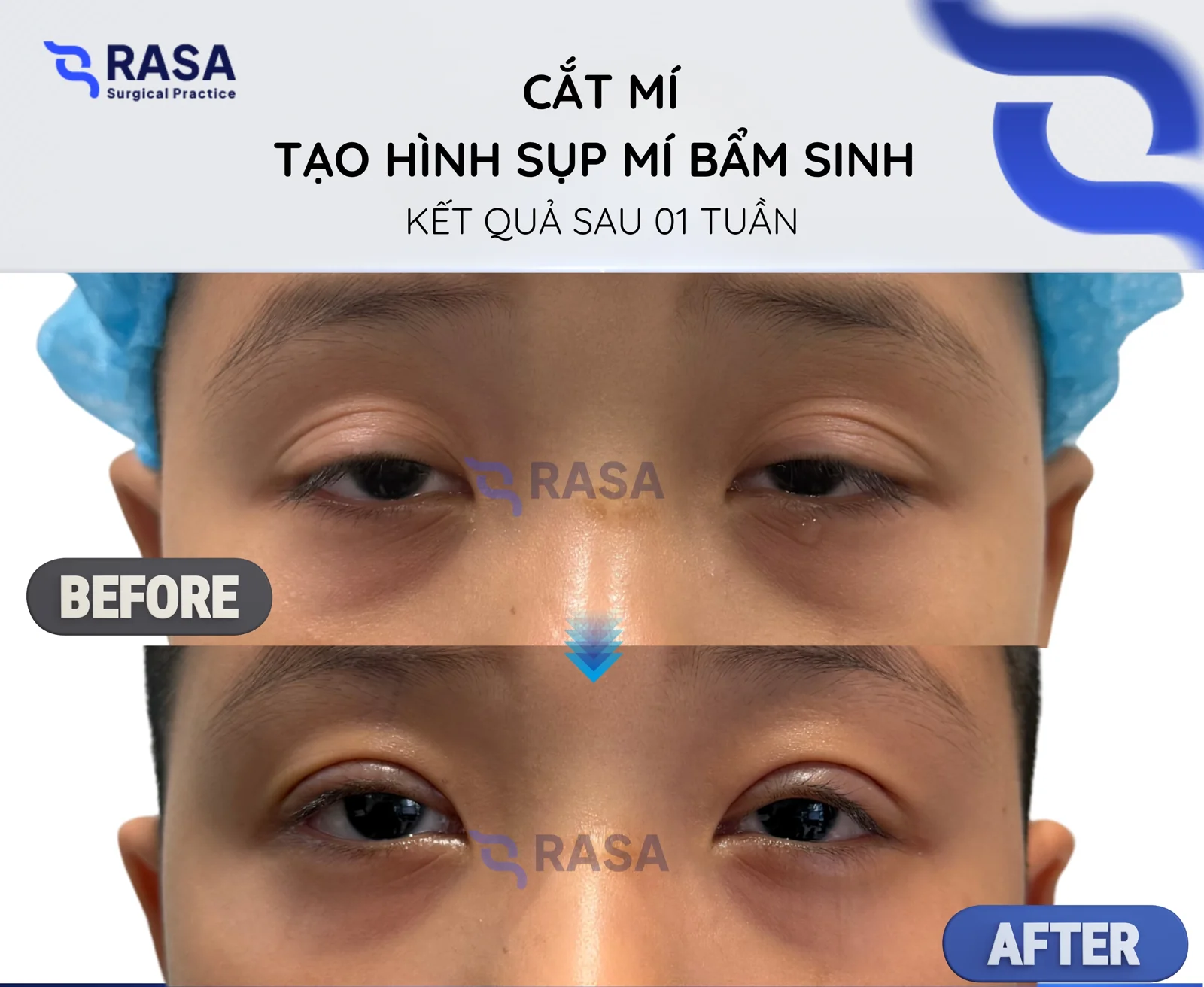 Blepharoplasty - congenital ptosis correction - After 1 week