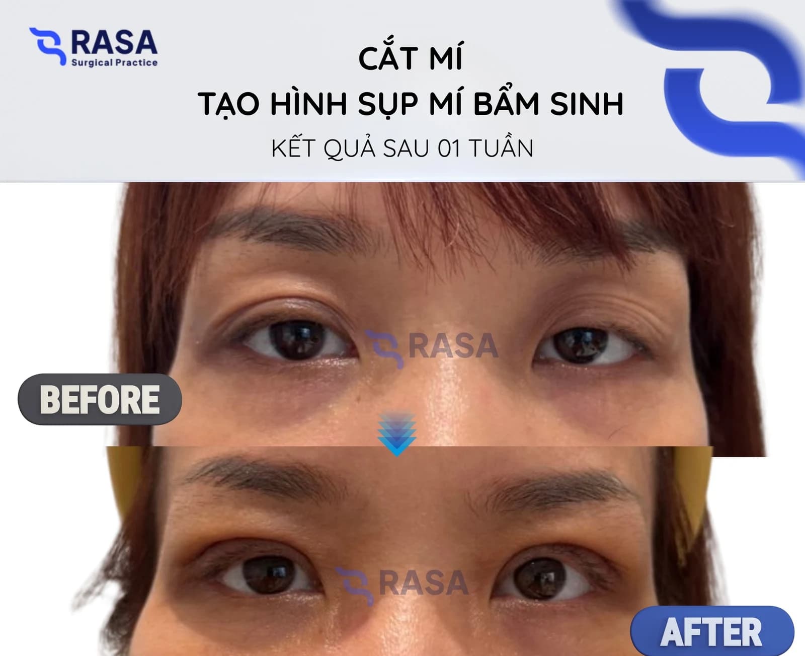 Cắt mí - tạo hình sụp mí bẩm sinh - Sau 1 tuần