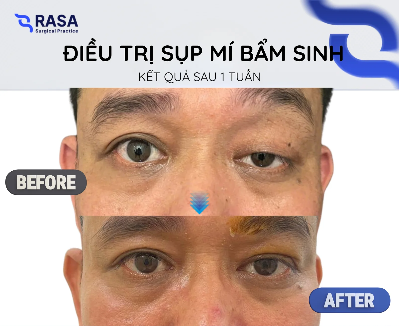Điều trị sụp mí bẩm sinh - Sau 1 tuần