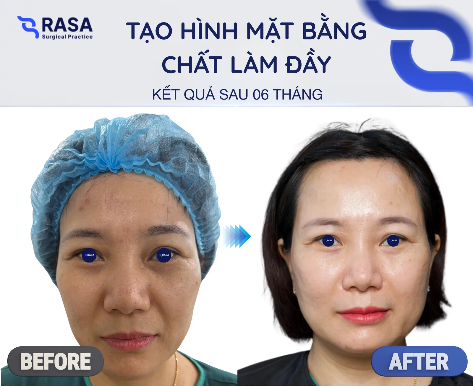 Tạo hình mặt bằng chất làm đầy - Sau 6 tháng