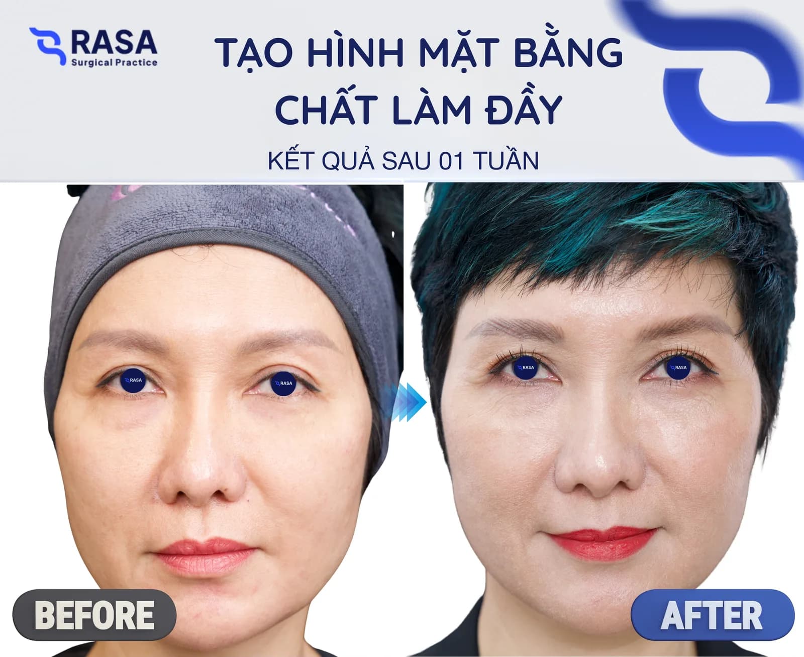 Tạo hình mặt bằng chất làm đầy - Sau 1 tuần