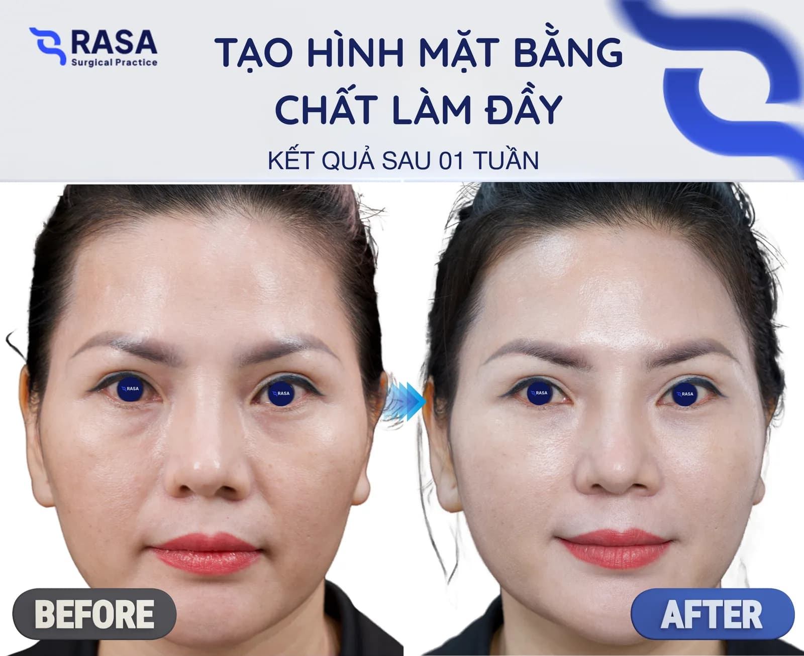 Tạo hình mặt bằng chất làm đầy - Sau 1 tuần
