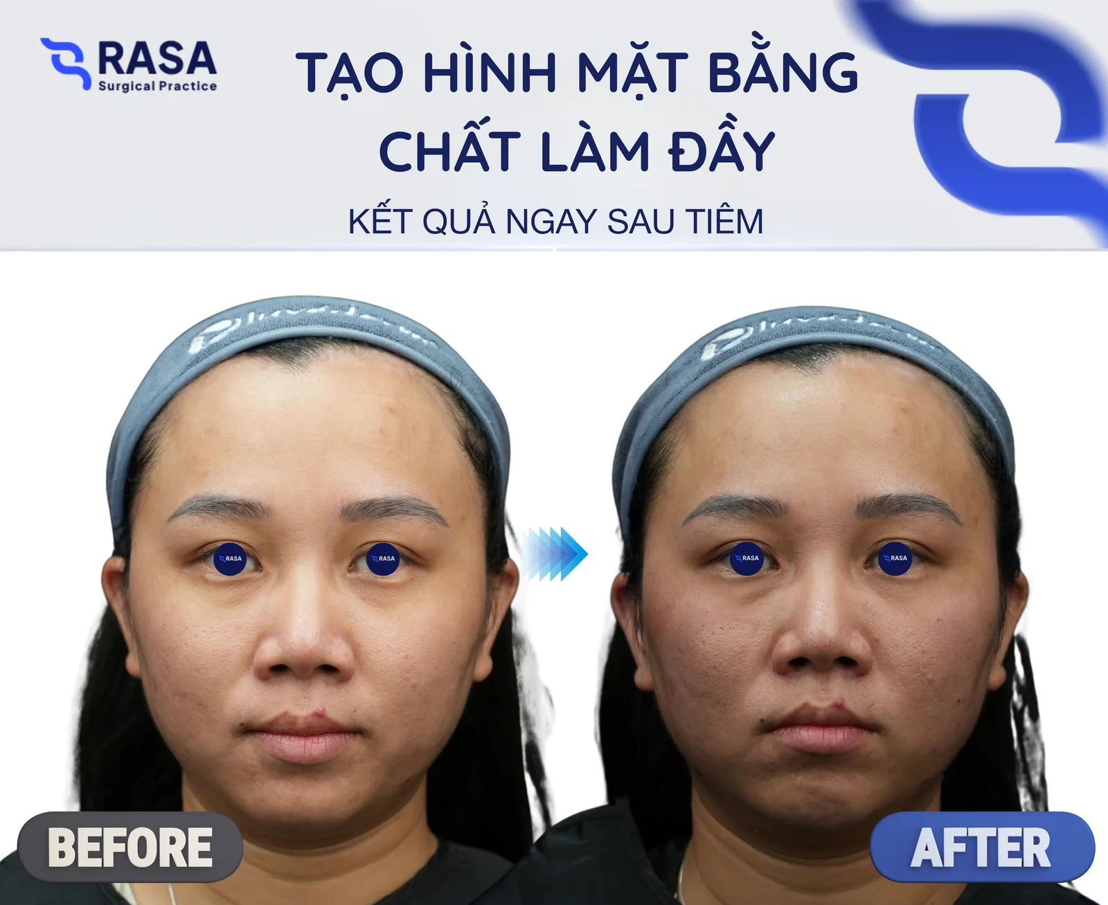 Tạo hình mặt bằng chất làm đầy - Sau 6 tháng