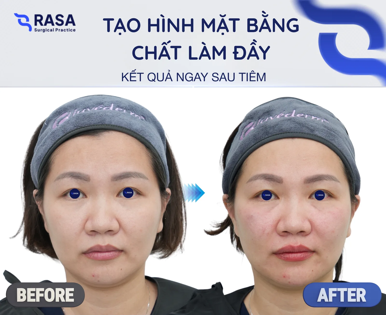 Tạo hình mặt bằng chất làm đầy - Sau tiêm