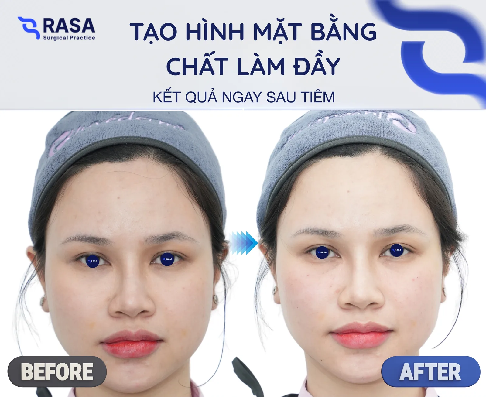 Tạo hình mặt bằng chất làm đầy - Sau tiêm