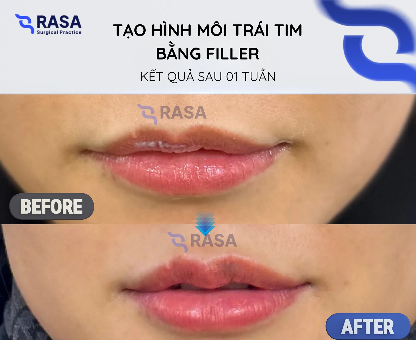 Tạo hình môi trái tim bằng chất làm đầy - Sau 1 tuần