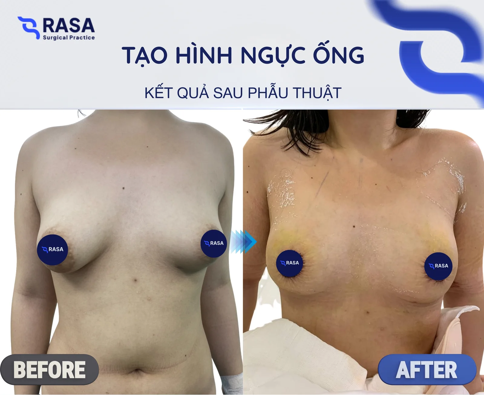 Tạo hình ngực ống - Sau phẫu thuật