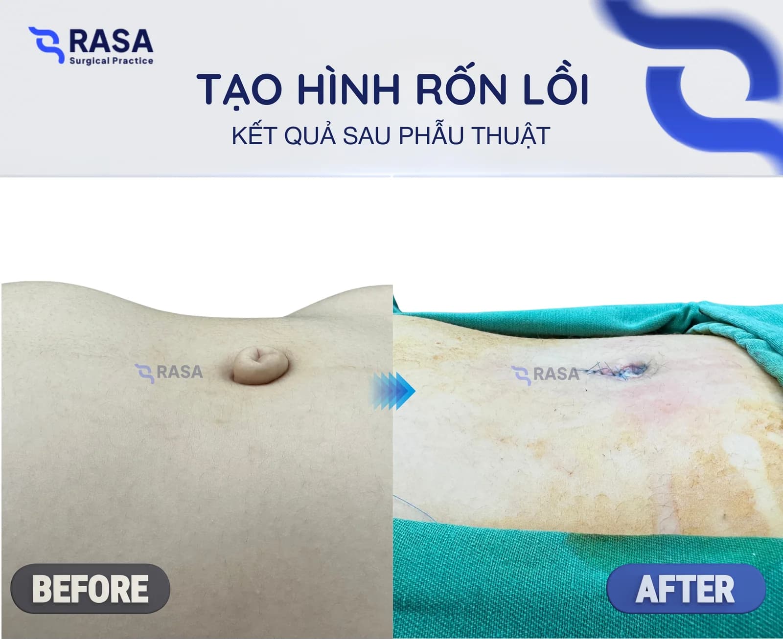 Tạo hình rốn lồi bẩm sinh - Sau phẫu thuật