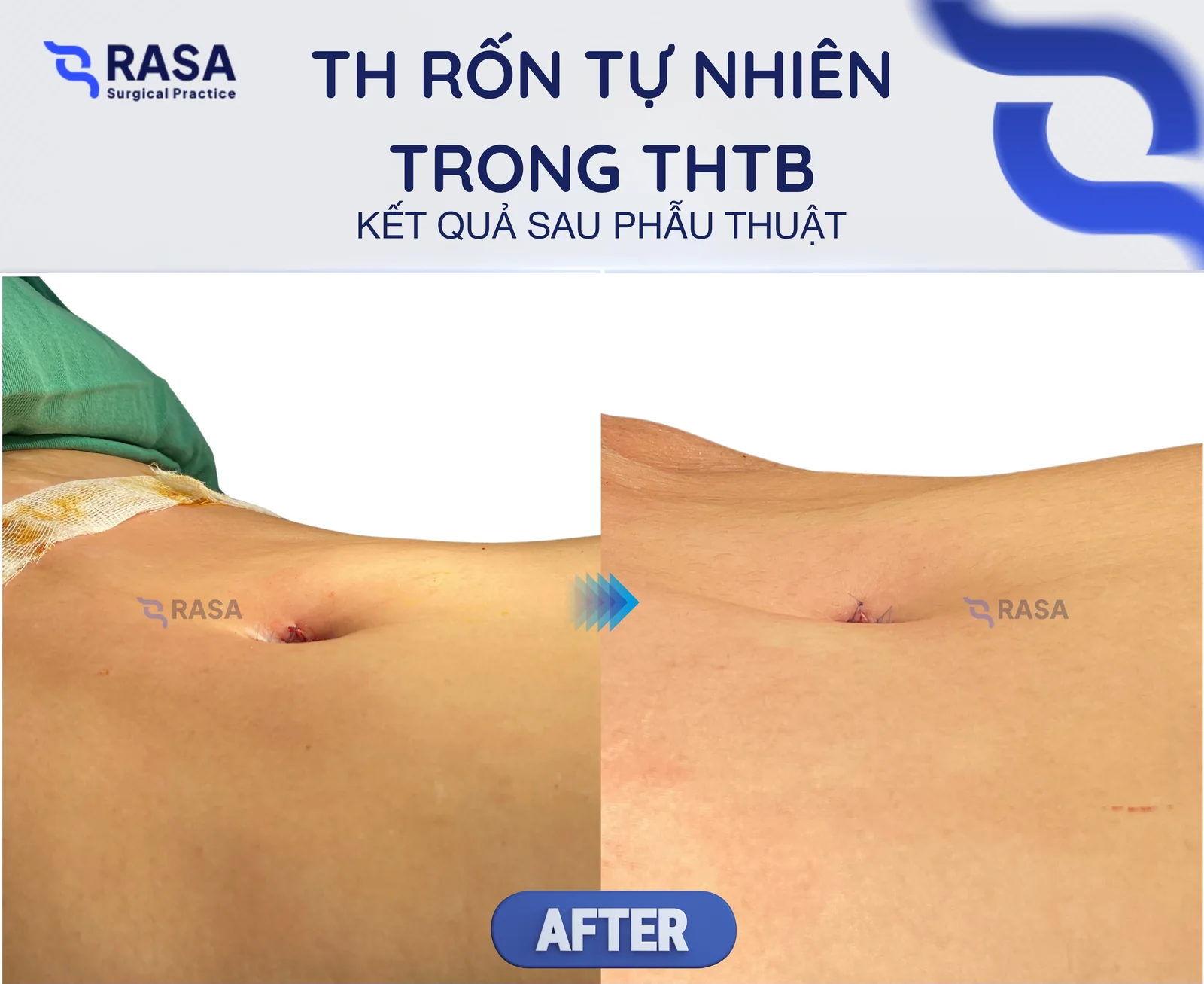Tạo hình rốn tự nhiên trong tạo hình thành bụng - Sau phẫu thuật