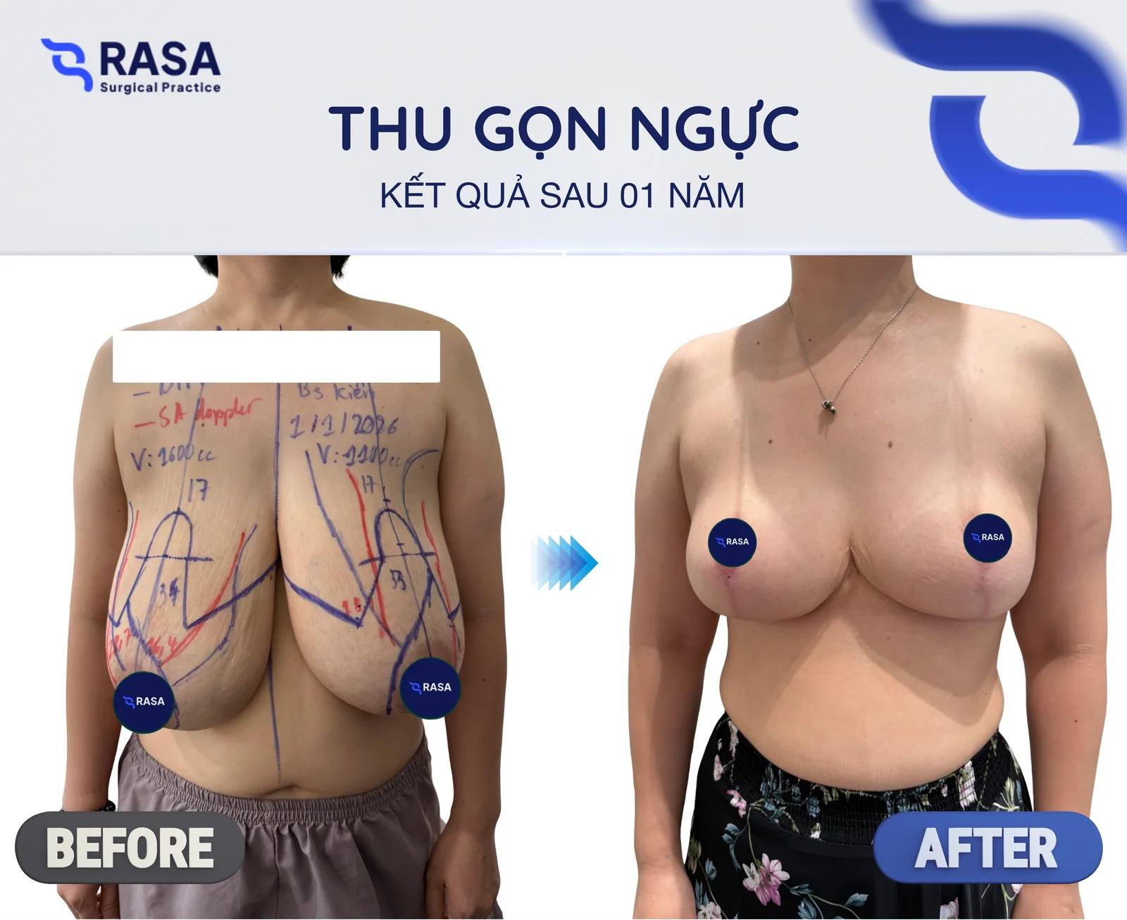 Thu gọn ngực phì đại - Sau 1 năm
