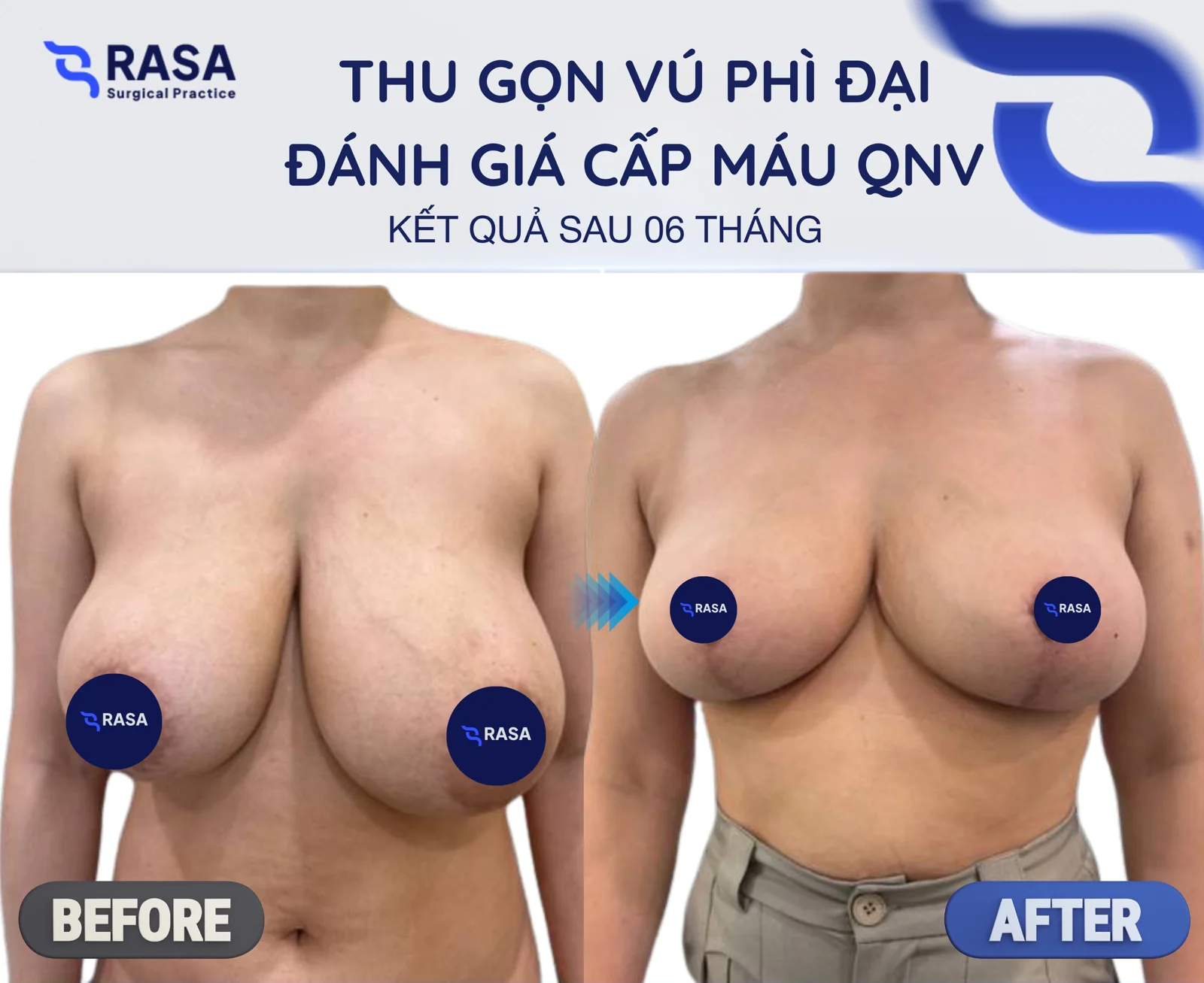 Breast reduction - After 6 months