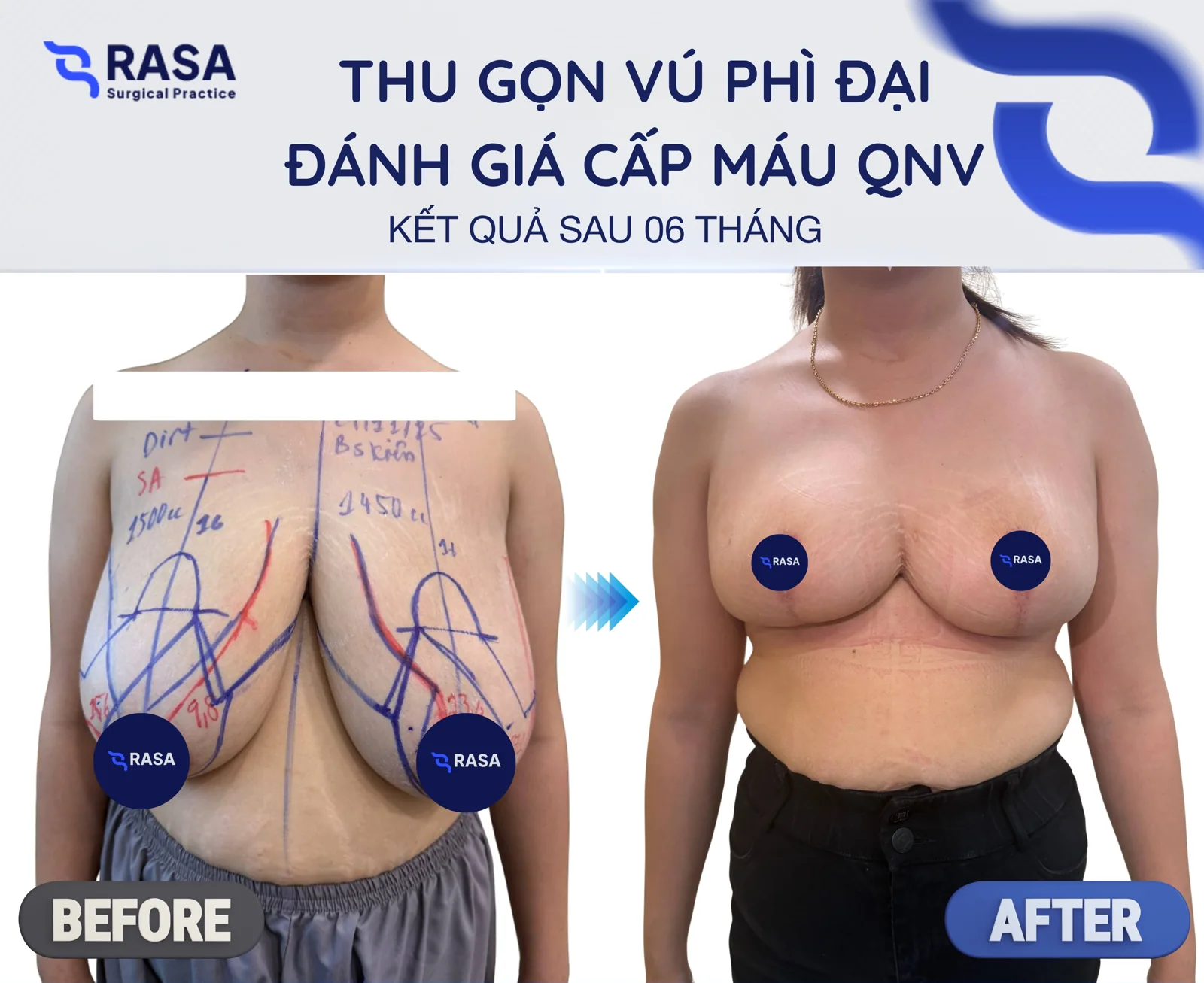 Breast reduction - After 6 months