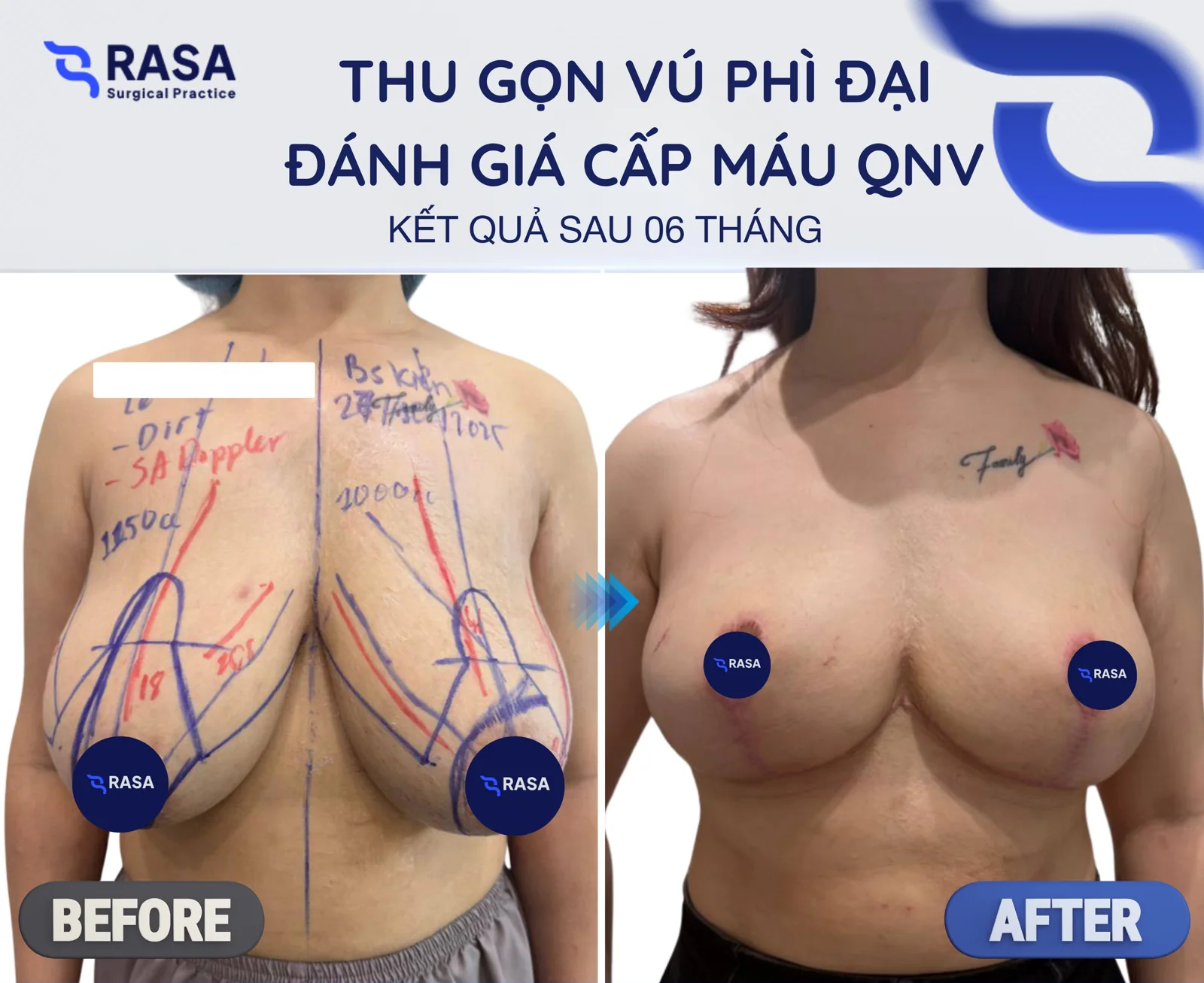 Breast reduction - After 6 months