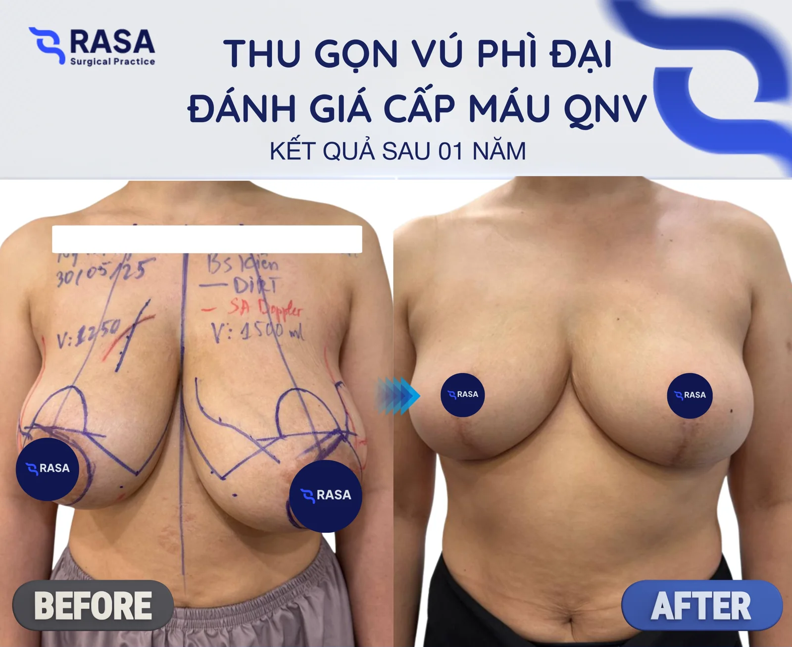 Breast reduction - After 1 year