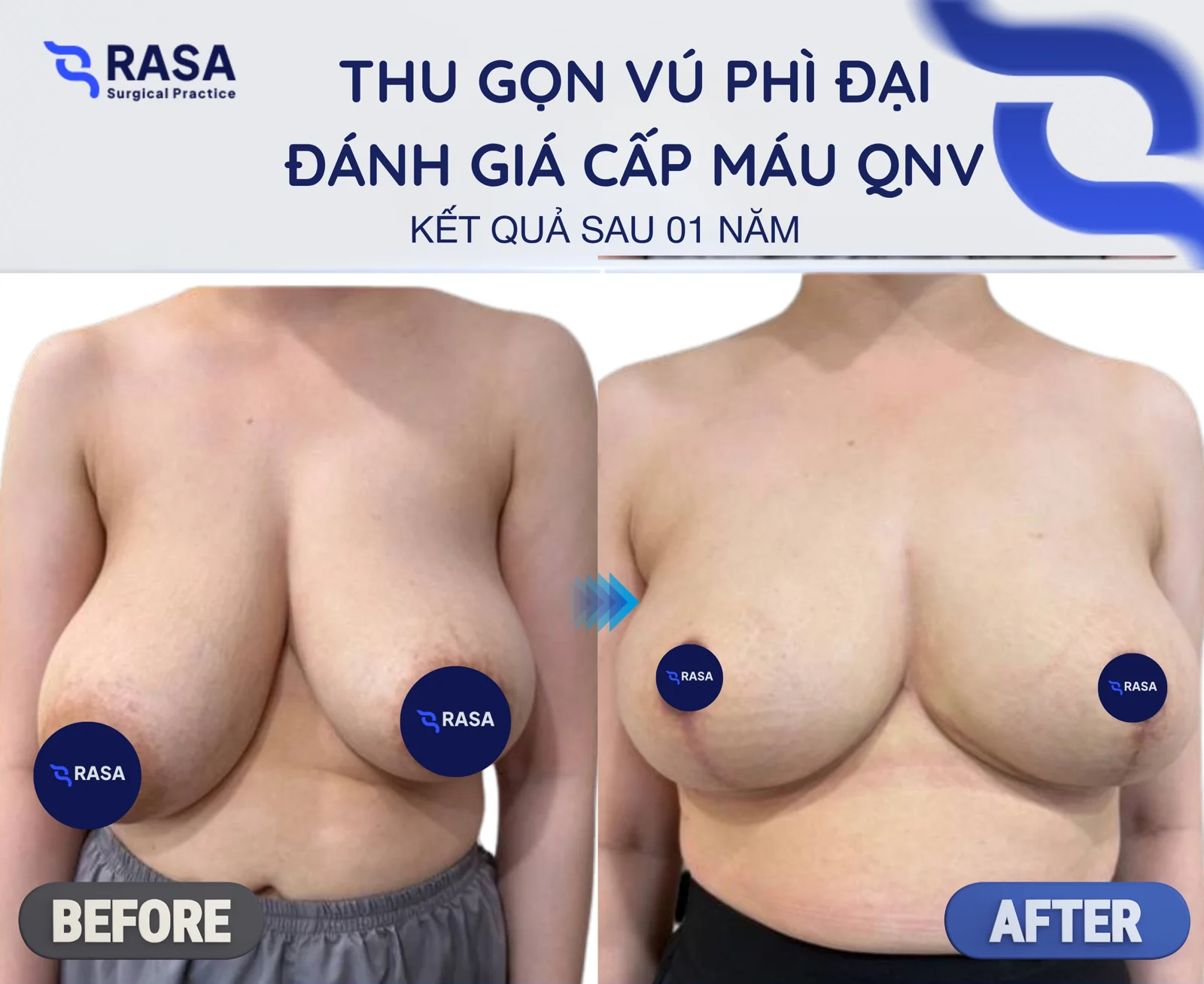 Breast reduction - After 1 year
