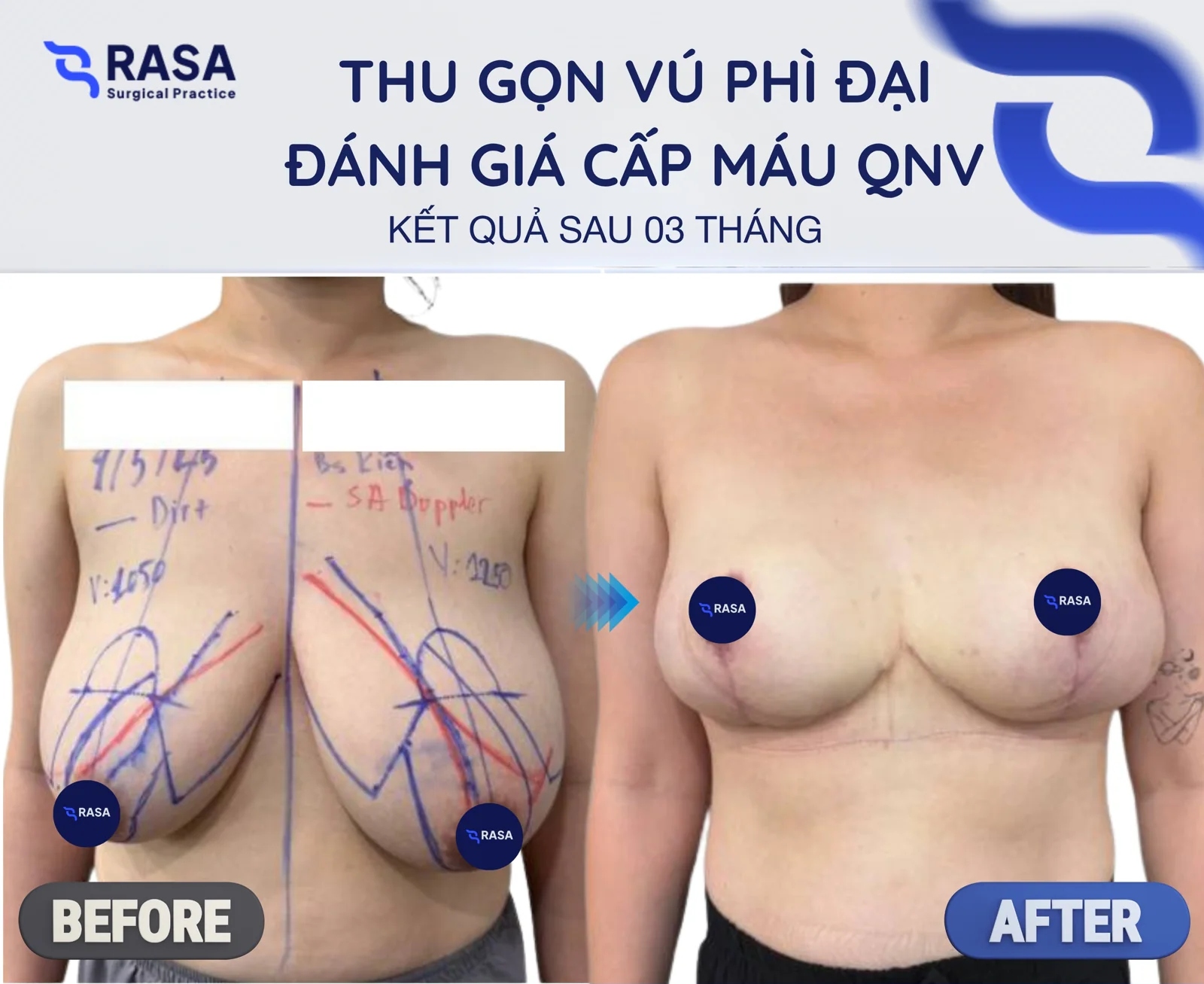 Breast reduction - After 3 months