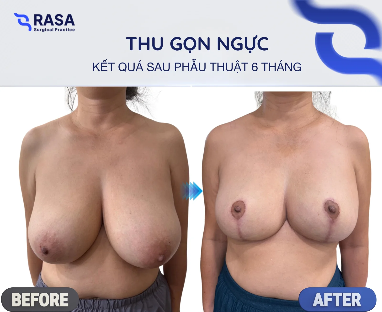Thu gọn ngực phì đại - Sau 6 tháng