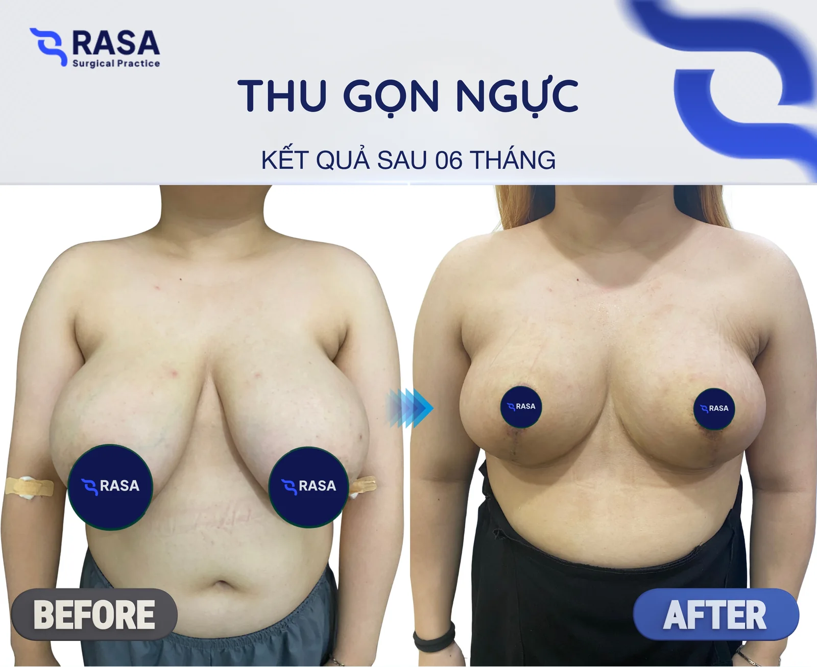 Thu gọn ngực phì đại - Sau 6 tháng