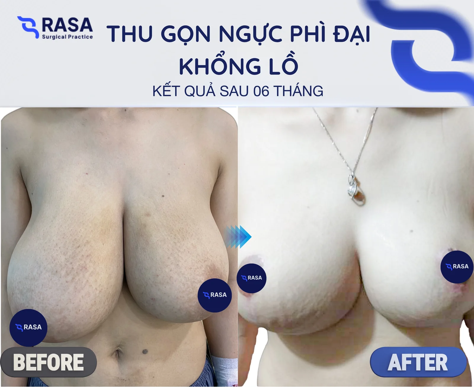 Thu gọn ngực phì đại khổng lồ - Sau 6 tháng