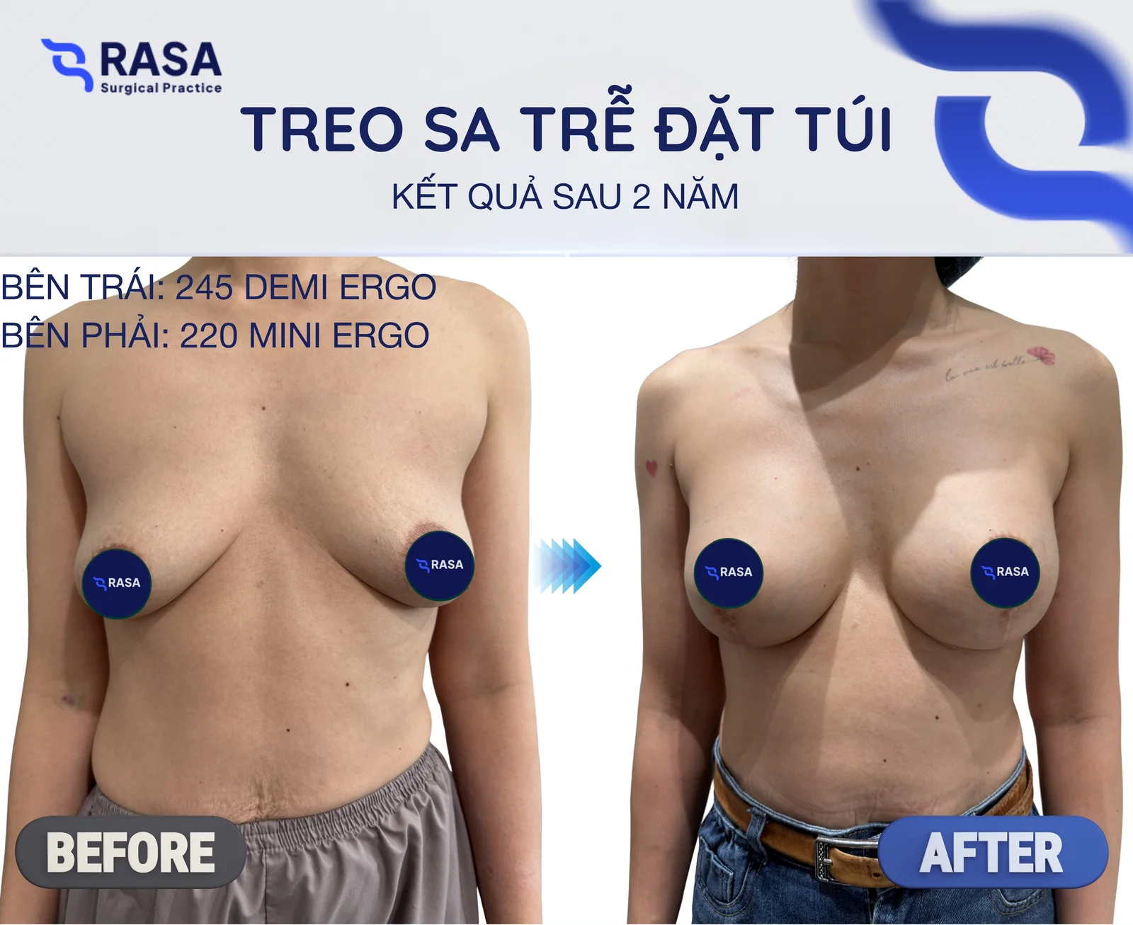 Treo sa trễ kết hợp đặt túi - Sau 2 năm