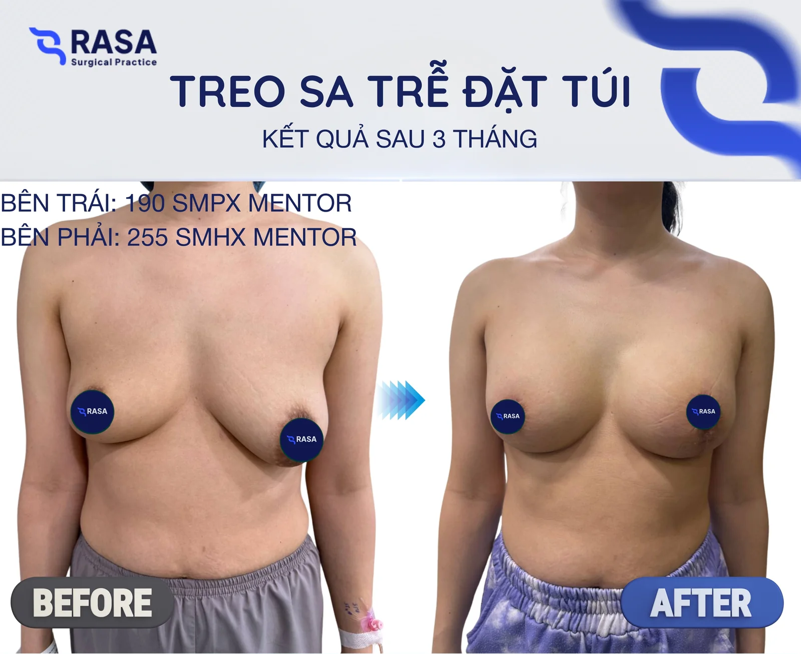 Treo sa trễ kết hợp đặt túi - Sau 3 tháng