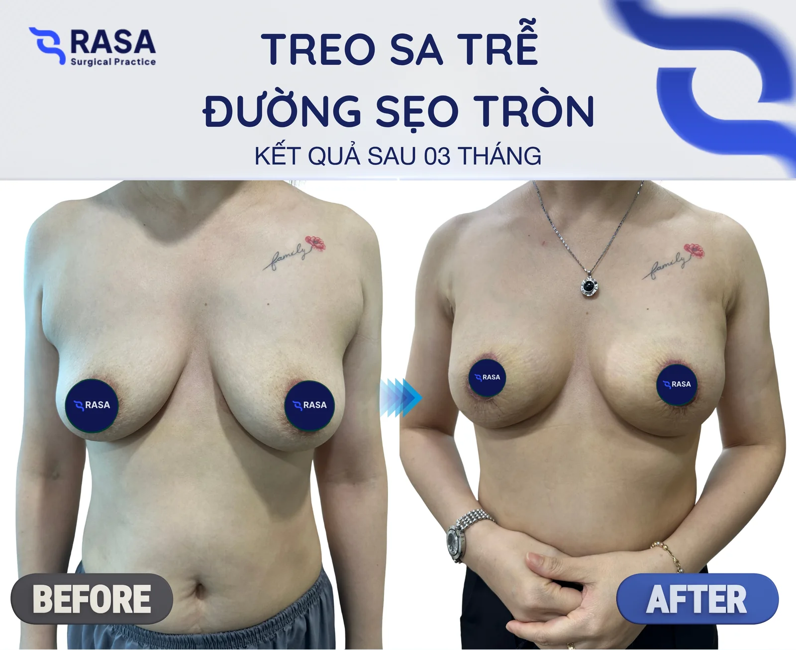 Treo sa trễ đường sẹo tròn - Sau 3 tháng