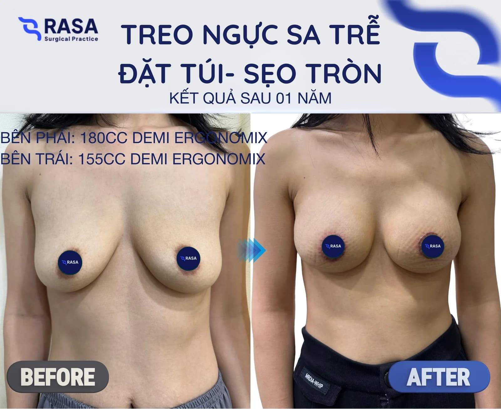 Treo sa trễ đặt túi - sẹo tròn - Sau 1 năm
