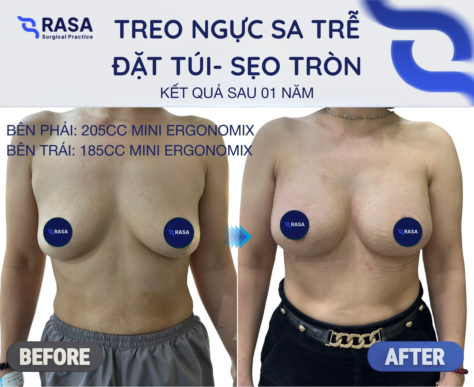 Treo sa trễ sẹo tròn - túi Mini - Sau 1 năm