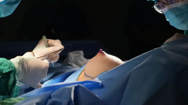 Chi tiết kỹ thuật phẫu thuật nâng ngực RASA